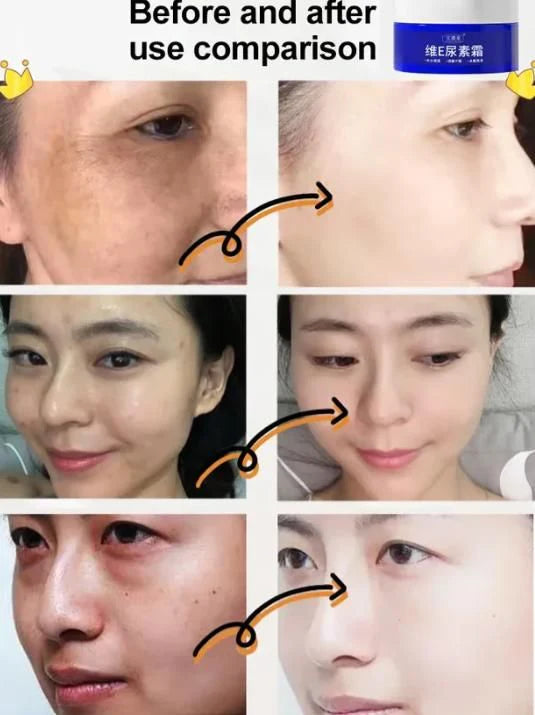 Korean Vitamin E Urea Cream 100g (BUY 1 GET 1 FREE 🔥)
